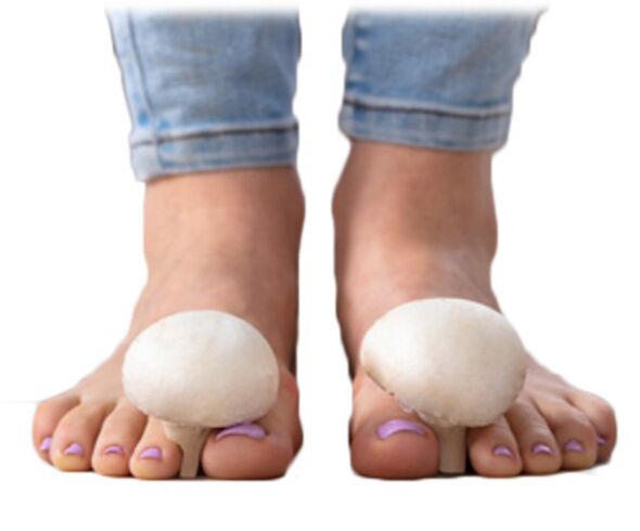 Micosi sulla superficie del piede e delle unghie