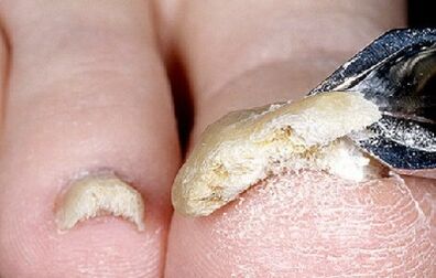 stadio avanzato di infezione da funghi alle unghie
