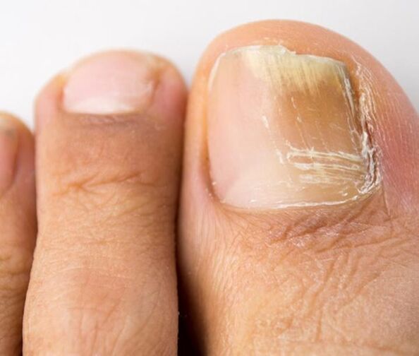 infezione fungina dell'unghia del piede