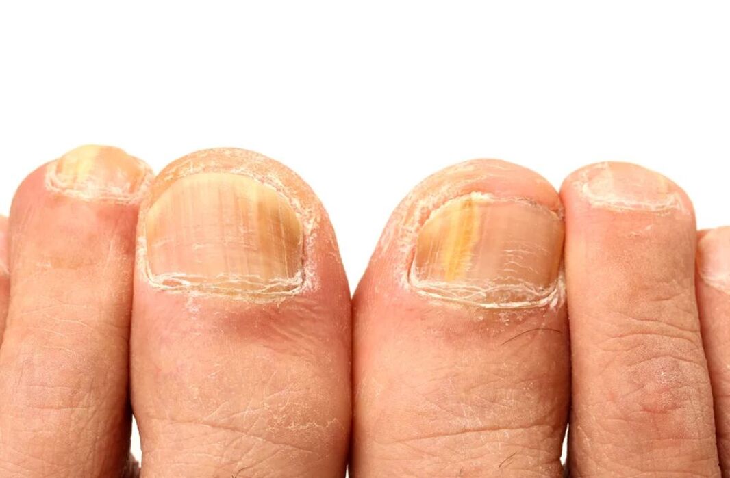 cause del fungo dell'unghia del piede