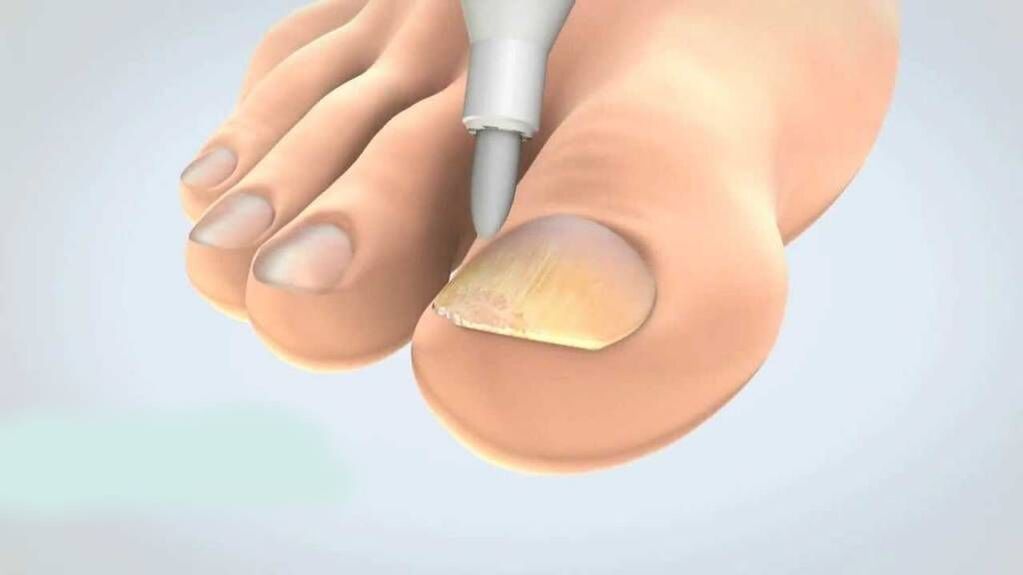 trattamento del fungo dell'unghia del piede