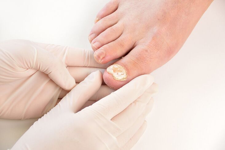Prima di prescrivere il trattamento, il medico deve diagnosticare il fungo delle unghie dei piedi