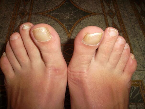 Ispessimento delle unghie dei piedi con onicomicosi