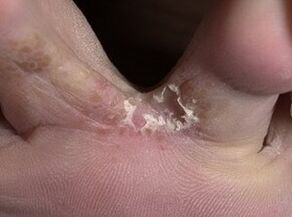 sintomi del fungo del dito del piede