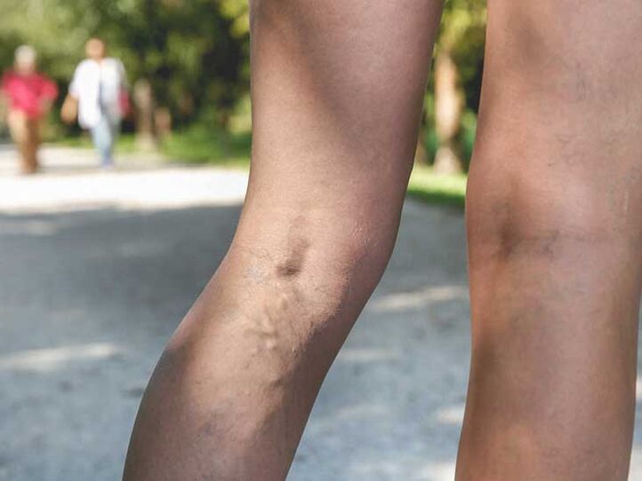Le vene varicose sono un fattore di rischio per l’infezione da funghi ai piedi