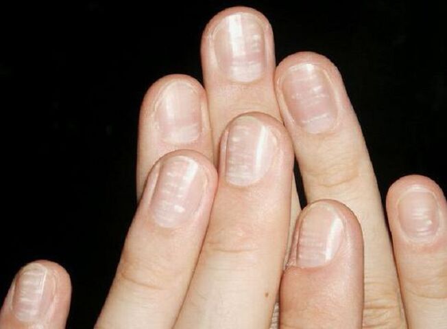 Le macchie bianche sulle unghie sono un segno dello sviluppo di funghi