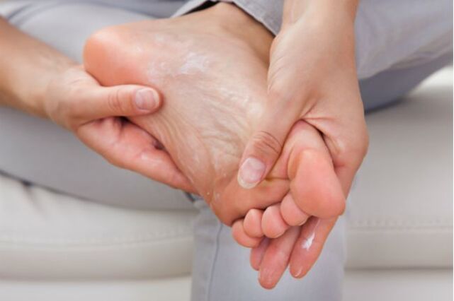 Creme e gocce antifungine aiuteranno nelle fasi iniziali del fungo dell'unghia del piede