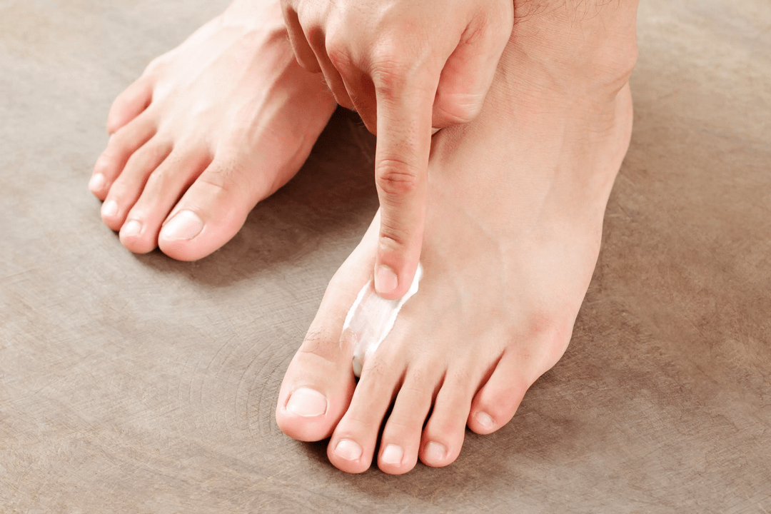 applicare un unguento antifungino sulla pelle del piede