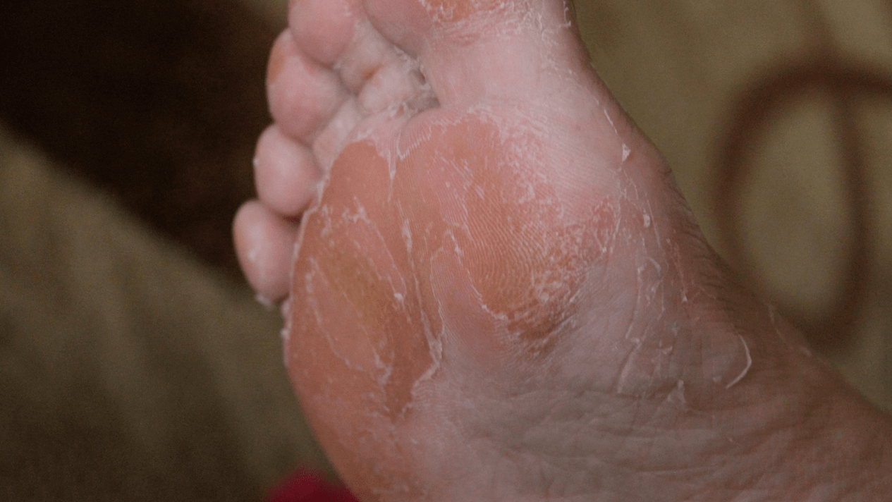 fungo della pelle del piede