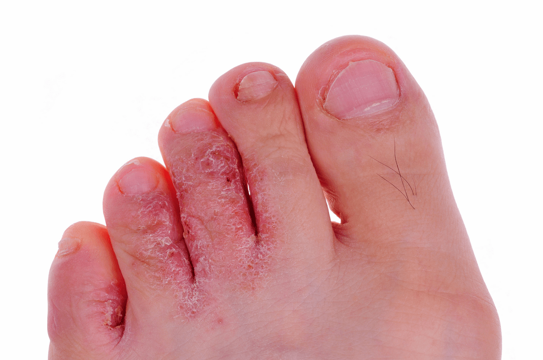 infezione fungina della pelle tra le dita dei piedi