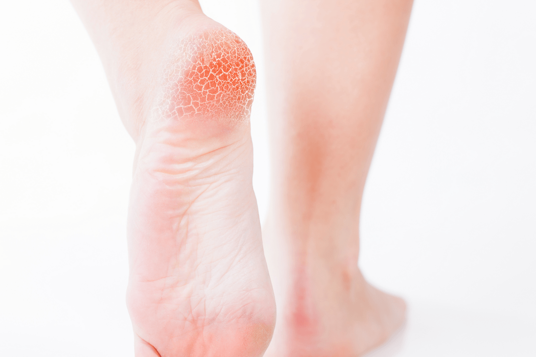 trattamento del fungo del piede in fase iniziale