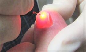 Trattamento del fungo delle unghie con un laser