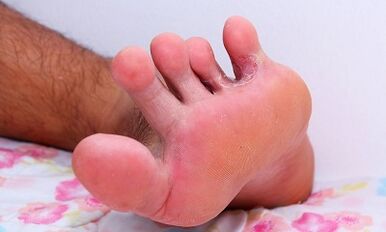 Le cause del fungo tra le dita dei piedi