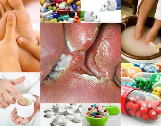 Micosi interdigitale e metodi di trattamento