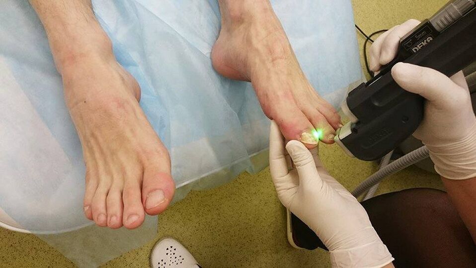 terapia laser per funghi alle unghie