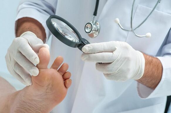 Cause e trattamento dei funghi sulle unghie dei piedi