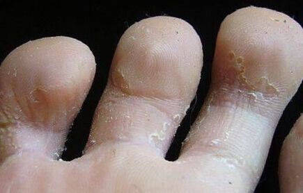 segni di funghi tra le dita