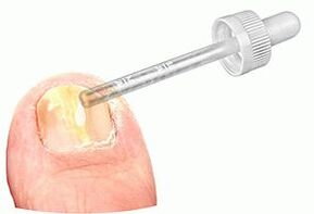 Applicazione di gocce medicinali su un'unghia colpita da funghi