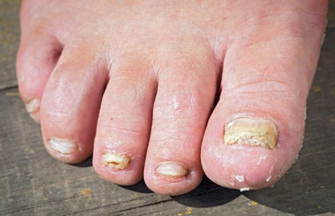 Fungo rubromicosi sui piedi