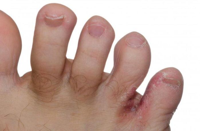 fungo sui piedi tra le dita