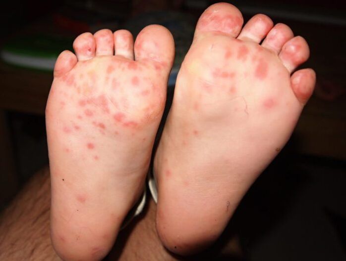fungo vescicolare sulle gambe