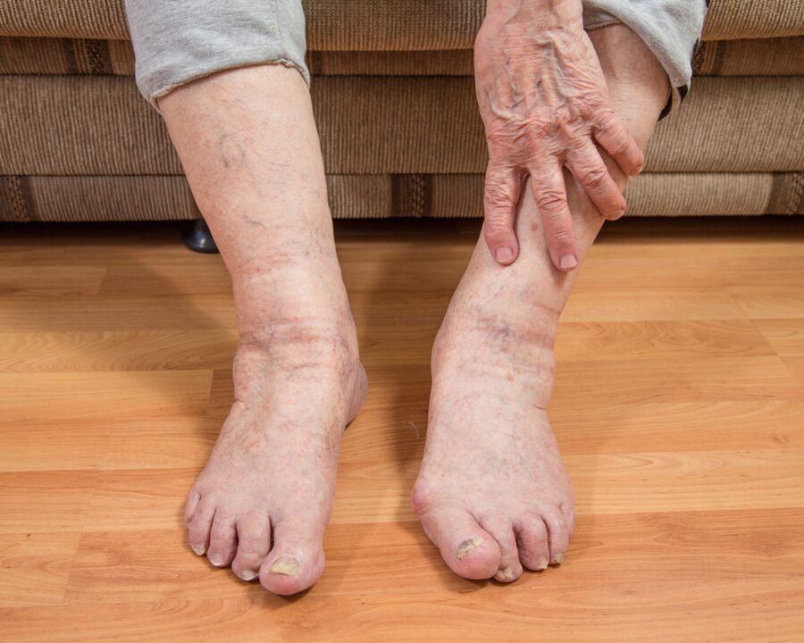 Per evitare la diffusione delle microspore fungine, non camminare a piedi nudi in casa.