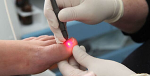 Terapia laser per i funghi delle unghie dei piedi